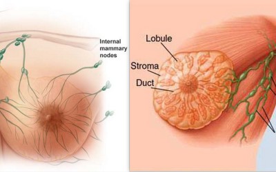 Male Breast Cancer – What Is Male Breast Cancer? What Causes Male Breast Cancer?